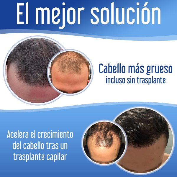 XPECIA - Tratamiento Anticaída del Cabello para Hombres, Bloqueador de DHT, Fórmula para el Crecimiento Capilar, 180 Pastillas Embalaje Deteriorado Fashion